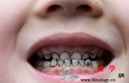 幼儿龋齿的症状不同位置症状不同_釉质-龋齿-缺损-骨质-