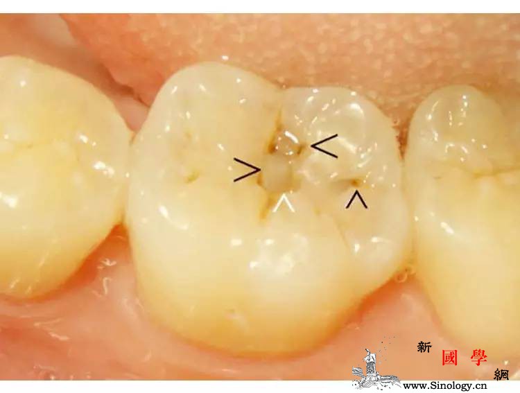 5种最常见宝宝牙病大揭秘_龋齿-牙龈-出血-牙齿-