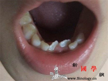 宝宝恒牙长歪了怎么办什么时候矫正最好呢_恒牙-换牙-矫正-畸形-