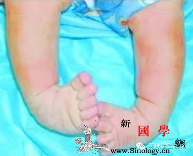太吓人！用了半年学步车女婴双脚变畸形…这些_菲菲-紫药水-婴儿-建议-