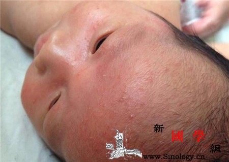 两个月婴儿湿疹怎么办_硼酸-患处-蒲公英-湿疹- ()