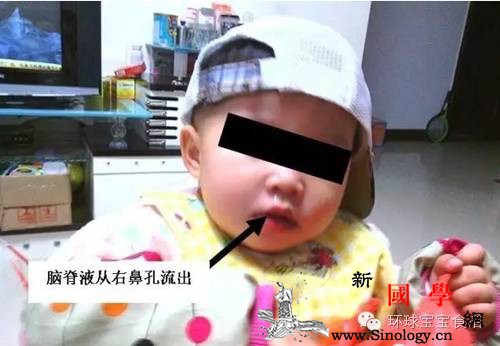 宝宝脑子里的东西竟漏出！常流这种“鼻涕”千万_脑脊液-鼻涕-液体-脑膜-