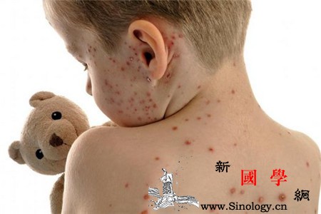 小孩出水痘一般几天好水痘通过什么途径传播的_结痂-水痘-几天-传染-