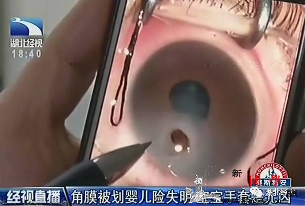 心疼！2月大宝宝眼角膜破了个洞元凶竟是这件_角膜-温馨提示-宝宝-孩子-