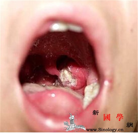 儿童扁桃体发炎有什么症状四大表现_扁桃体-感觉到-症状-表现-