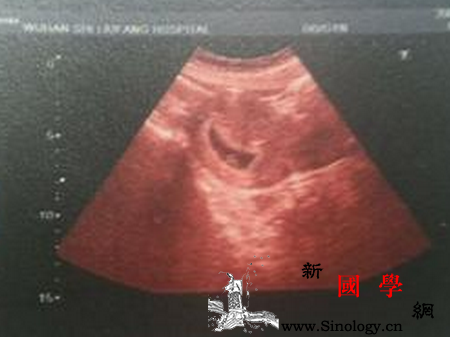 怀孕4周能看见孕囊吗_羊膜-着床-胎盘-胚胎-