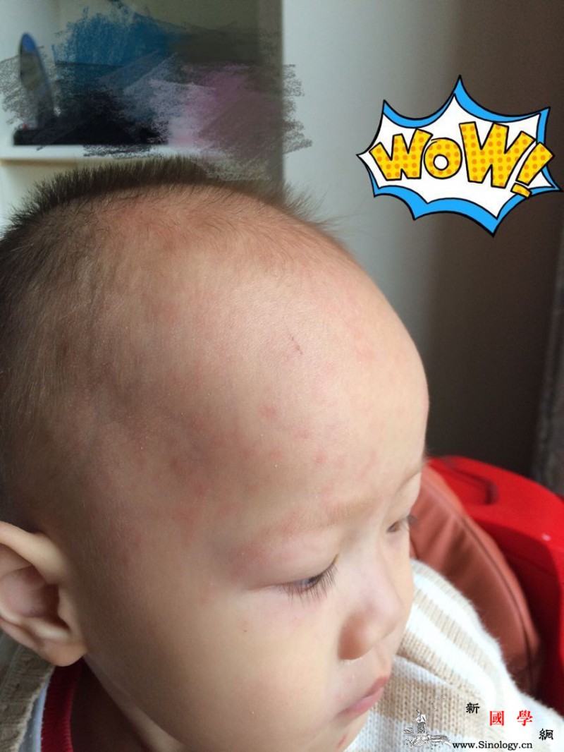 幼儿急疹宝妈别慌张_疹子-皮疹-感染-幼儿-