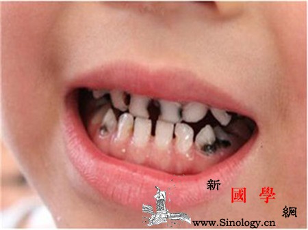 小孩蛀牙会影响换牙吗_换牙-龋齿-蛀牙-刷牙-