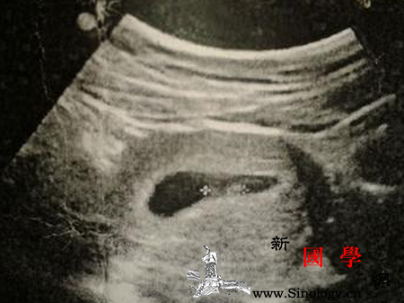 怀孕5周能看到孕囊吗_截面-受孕-截取-胎儿-