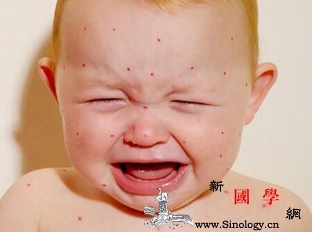 宝宝冬天脸红干燥是怎么回事_湿疹-脸部-脸红-干燥-