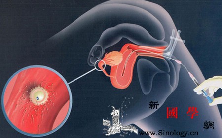 人工授精与试管婴儿是一回事吗？_试管婴儿-精液-精子-治疗-怀孕准备