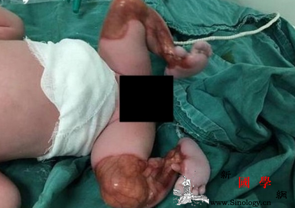 新生儿双腿透明凭肉眼可见肌肉和毛细血管_毛细血管-男婴-死亡率-双腿-