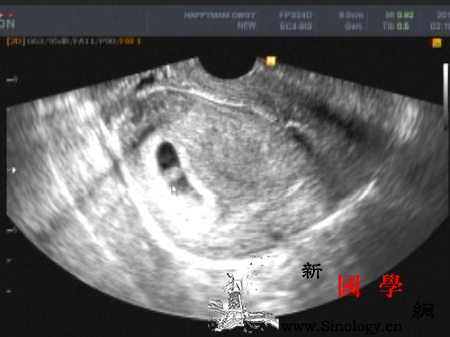 怀孕6周孕囊有多大_宫外孕-胎儿-孕妇-偏小-