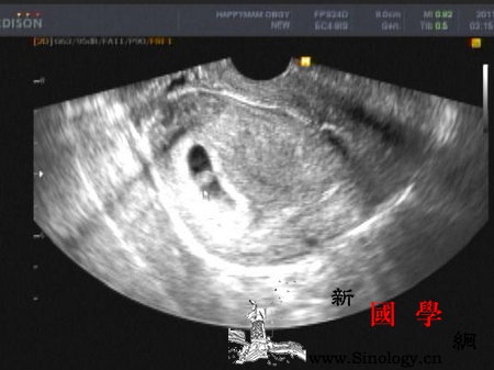 怀孕7周妊娠囊有多大_胎盘-孕期-妊娠-胎儿-