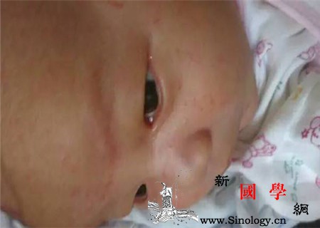 宝宝湿疹症状图片有哪些_丘疹-结痂-尿布-渗出-
