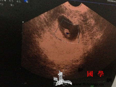 怀孕8周没有胎心胎芽正常吗_还没有-胚胎-妊娠-胎儿-