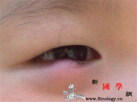宝宝麦粒肿会自愈吗_麦粒肿-腺体-热敷-毛巾-