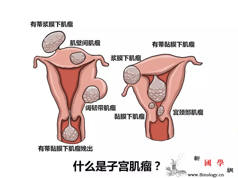 了解子宫肌瘤不再“谈肌瘤色变”！_绝经-雌激素-肌瘤-妊娠-孕前检查