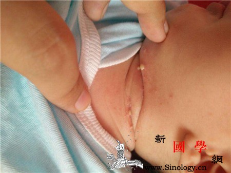 宝宝脖子褶皱处磨红了老不好怎么办教你几招解_红霉素-褶皱-红了-脖子-
