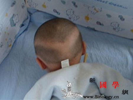 佝偻病的早期症状及早发现更利于治疗_佝偻病-闭合-出汗-顶骨-