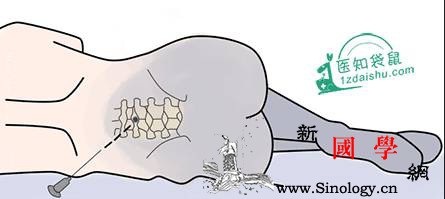 剖腹产：要挨几刀缝几层？产后如何护理恢复快_剖腹产-胎儿-子宫-麻醉-