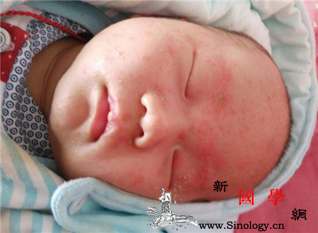 宝宝1个月屁股上有湿疹了怎么办推荐几种祛湿_金霉素-上有-几种-湿疹-
