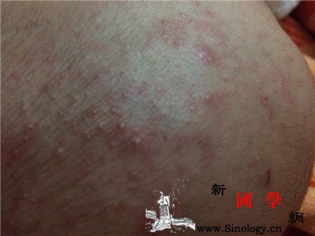 宝宝头上长痱子怎么办教你几个小妙招轻松搞定_痱子-患处-头上-几个-