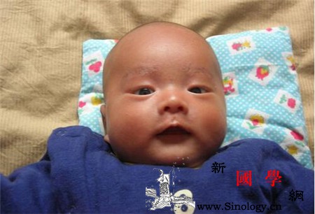 奶藓和湿疹的区别宝宝奶藓怎么办_软膏-水解-糖浆-湿疹-