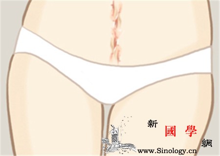 剖腹产伤口去疤的药这几款让你变回美少女_剖腹产-疤痕-伤口-皮肤-