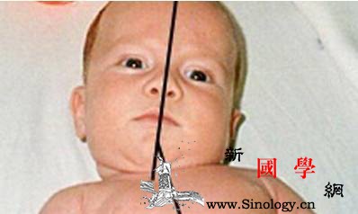 宝宝斜颈的表现小儿斜颈有哪些不同类型_斜颈-颈部-倾斜-头部-