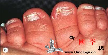 宝宝指甲上有白点需要看医生吗？_趾甲-白点-修剪-指甲-