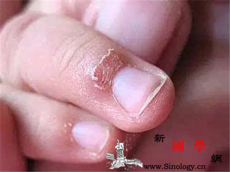 宝宝长倒刺是缺什么要怎么办呢？_倒刺-生长发育-护理-缺什么-
