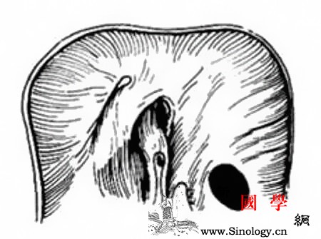 先天性膈疝是什么原因_裂孔-角形-肺泡-胸骨-