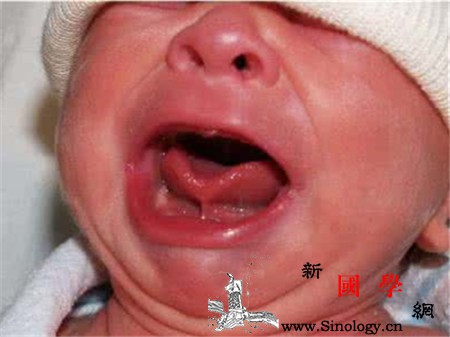 舌系带短的宝宝有什么症状这几个最明显的症状_舌系带-吸吮-吃奶-症状-