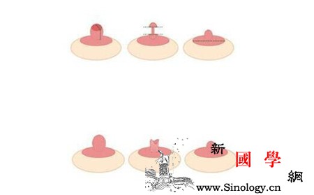 乳头内陷的程度区分图乳头内陷分为几个程度呢_牵拉-几个-导管-乳头-怀孕准备