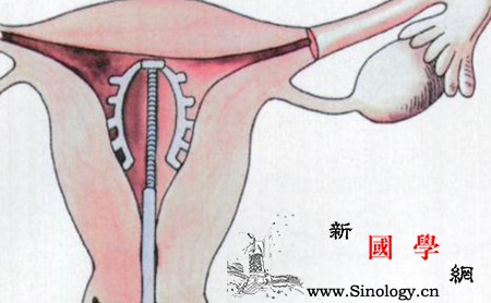 取环什么时候取最好？妇女取环的最佳时间_铜环-避孕环-月经-避孕-