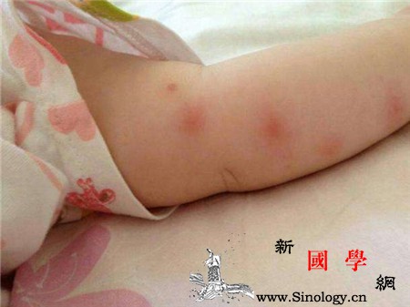 宝宝被蚊虫叮咬会引起发烧吗如何保护宝宝不被_破口-叮咬-蚊虫-纱布-