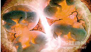 四维彩超直击：子宫里的多胞胎(组图)_首次-胎儿-双胞胎-四维-