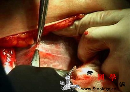 剖腹产后伤口的处理剖腹产伤口的全套处理_拆线-剖腹产-剖腹-止痛-