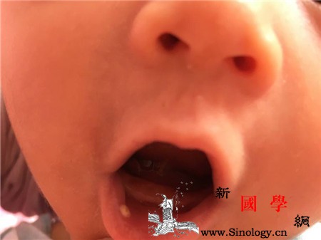 宝宝鹅口疮的症状有哪些要怎样才能预防呢_软腭-鹅口疮-创面-粘膜-