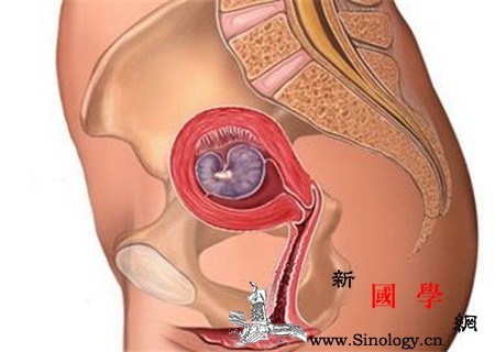 子宫息肉是怎么回事这些因素要预防_息肉-雌激素-炎症-激素-