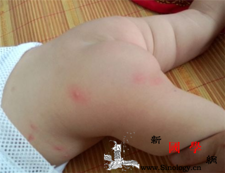 宝宝发烧后起疙瘩怎么回事宝宝发烧要谨防拍热_退热-后起-怎么回事-谨防-