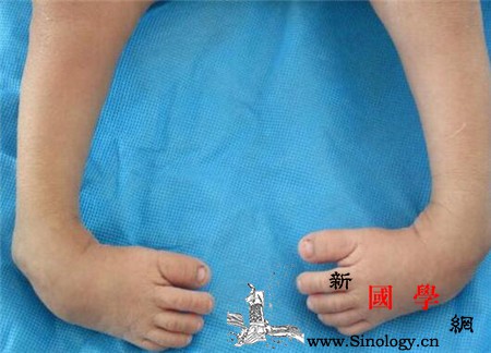 马蹄内翻足原因先天性马蹄内翻足是遗传导致的_软组织-马蹄-畸形-遗传-