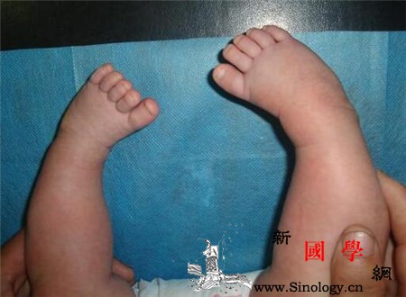 马蹄内翻足遗传概率直系和旁系几率不一样_遗传性-因人而异-马蹄-几率-