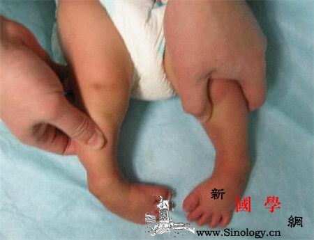 儿童马蹄内翻足到哪看家长应该选择大医院的骨_骨科-马蹄-家长-治疗-