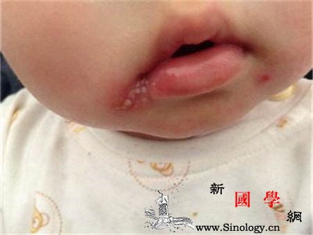 宝宝感染疱疹初期症状是什么疱疹病毒严重或可_水疱-疱疹-初期-症状-
