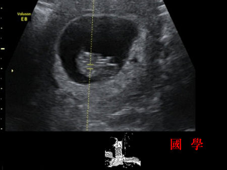 怀孕9周妊娠囊有多大_胎盘-胚胎-妊娠-胎儿-