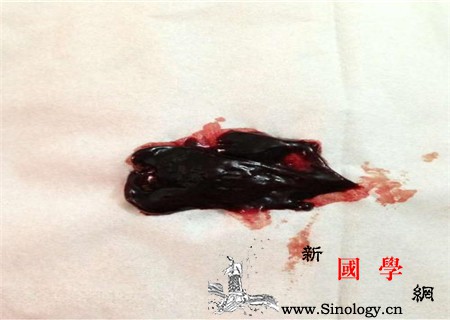 怎么判断恶露是否正常恶露什么颜色是正常的_血块-粘液-鲜红色-产后-