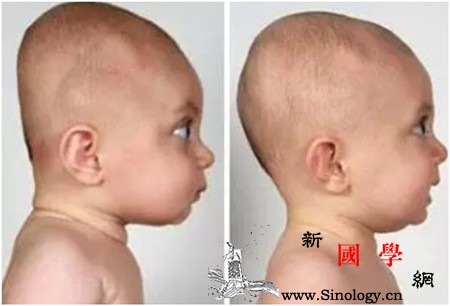 宝宝头型几个月定型睡偏了如何纠正_头型-几个月-颈部-定型-