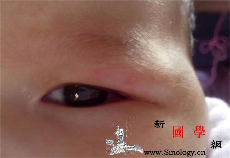 宝宝眼睛肿是怎么回事_蛋白尿-肾病-水肿-胆固醇-